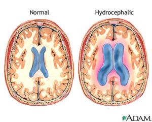 Normal vs.Hydrocephalic Ventricles